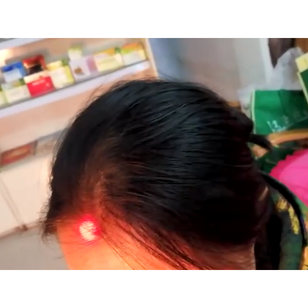 【视频】小夏老师给鼻塞患者做热敏灸
